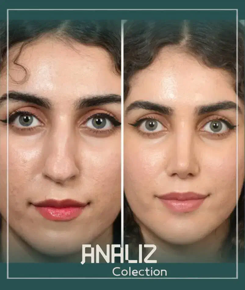 آفر ویژه عمل بینی /پلک /دندان/لیپوساکشن/غبغب|خدمات آرایشگری و زیبایی|شیراز, عفیف‌آباد|دیوار