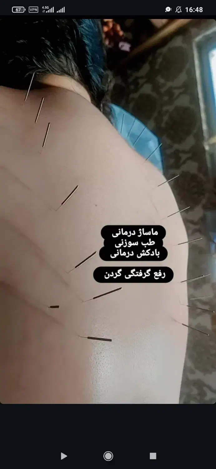 حجامت ، طب سوزنی ، امبدینگ ، بادکش درمانی|خدمات آرایشگری و زیبایی|اندیشه, اندیشه فاز ۳|دیوار