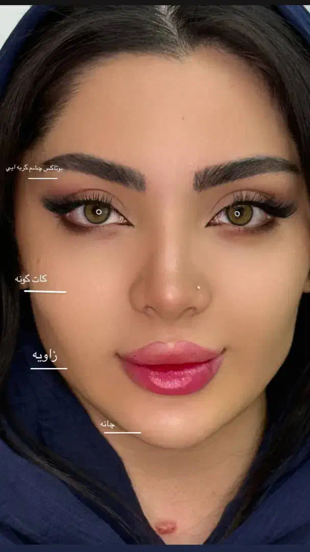 جشنواره تخفیف تزریق ژل و بوتاکس کانتورینگ فیشیال|خدمات آرایشگری و زیبایی|کرج, گلشهر|دیوار