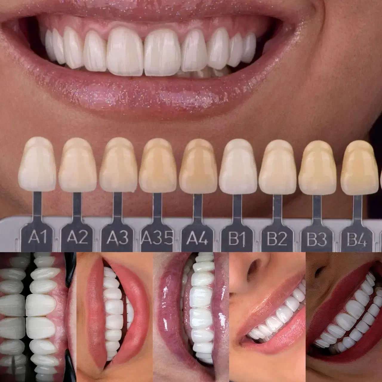 کامپوزیت دندان جشنواره لمینت ایمکس|خدمات آرایشگری و زیبایی|تهران, شمس‌آباد|دیوار