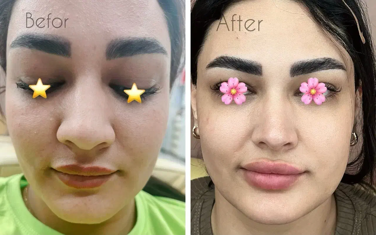 ژل بوتاکس کانتورینگ صورت آنزیم فیلر بینی مزوژل|خدمات آرایشگری و زیبایی|گرمسار, |دیوار