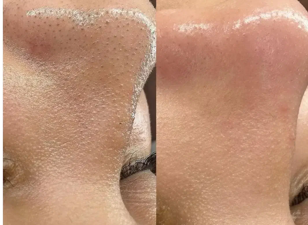 تخفیف یلدایی پاکسازی پوست فقط ۵۰۰تومن|خدمات آرایشگری و زیبایی|محمدیه-قزوین, |دیوار