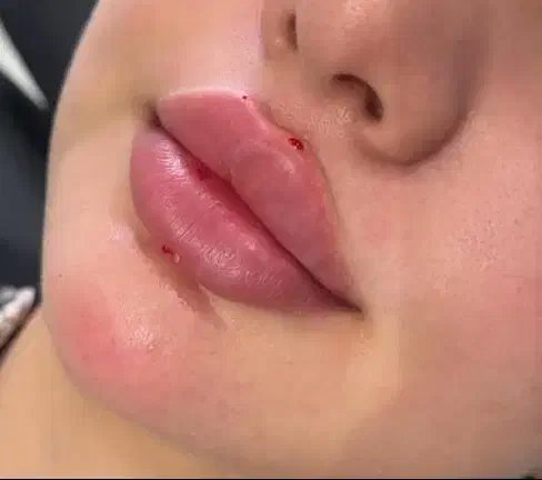 تخفیف فوق العاده خدمات ژل و بوتاکس در مطب|خدمات آرایشگری و زیبایی|شاهینشهر, بوستان حافظ|دیوار