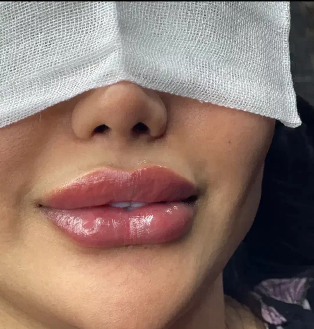 ترزیق ژل و بوتاکس،تخصصی و تضمینی|خدمات آرایشگری و زیبایی|نورآباد, |دیوار