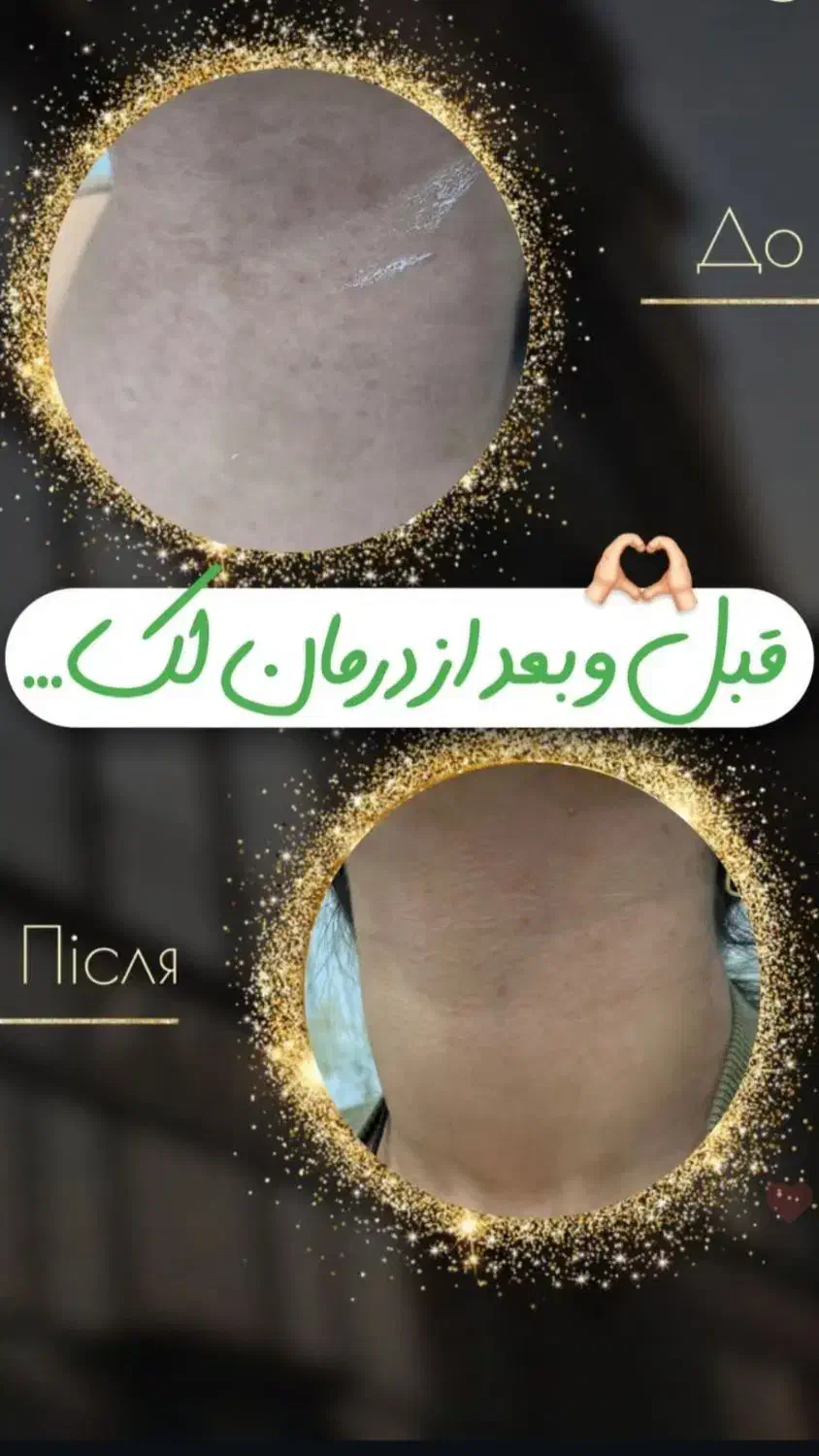 درمان حرفهای لک و ککومک و مزو تراپی|خدمات آرایشگری و زیبایی|برازجان, |دیوار