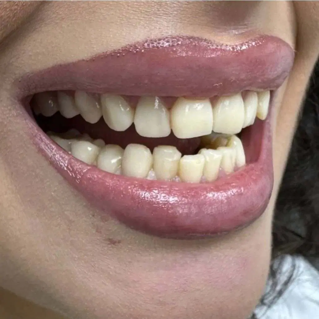 بلیچینگ دندان در دولت‌آباد/مشاوره اولیه رایگان|خدمات زیبایی و سلامت|تهران, دولت‌آباد|دیوار