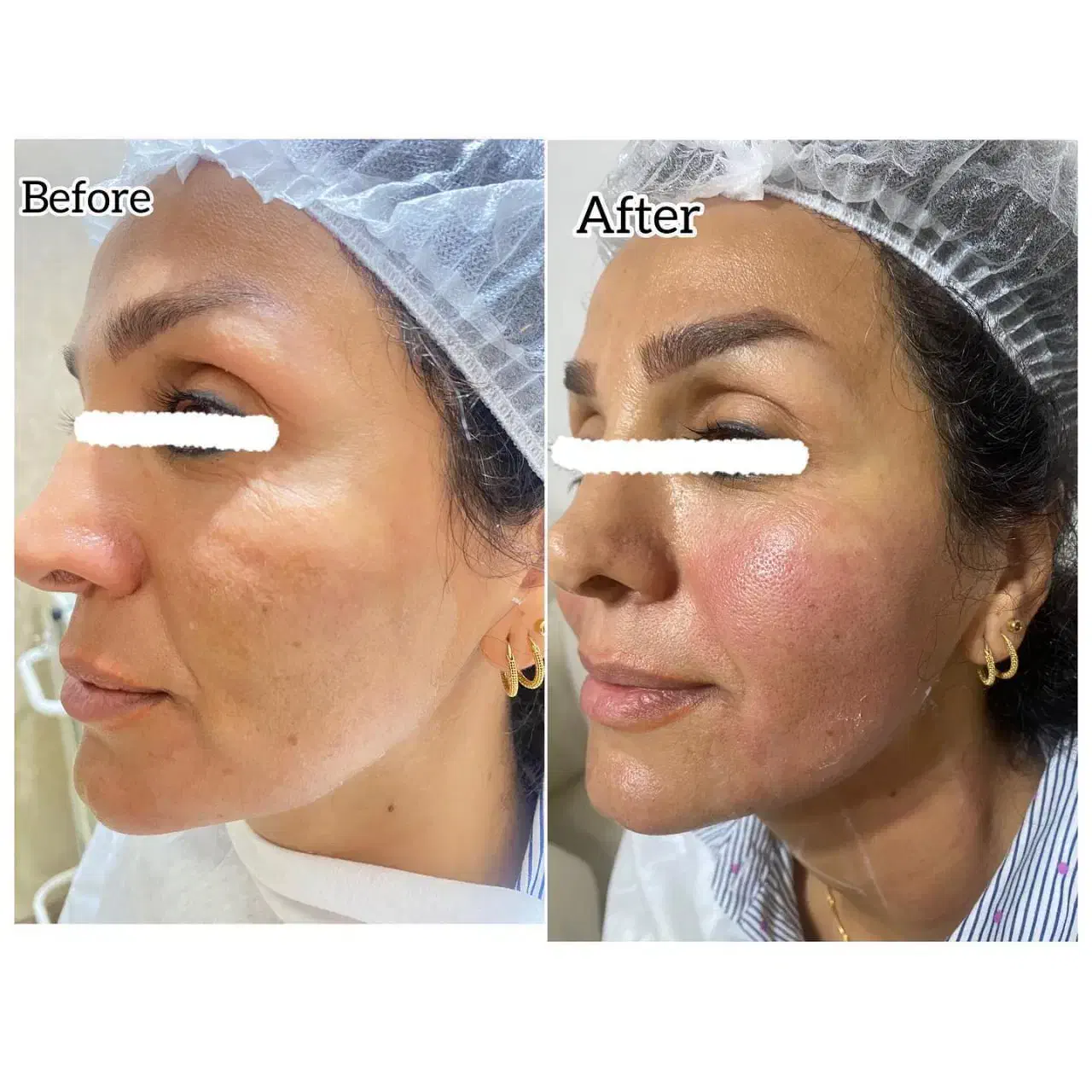 جشنواره هایفو ولیزر به مناسبت افتتاحیه ویلدا|خدمات آرایشگری و زیبایی|مشهد, آزادشهر|دیوار