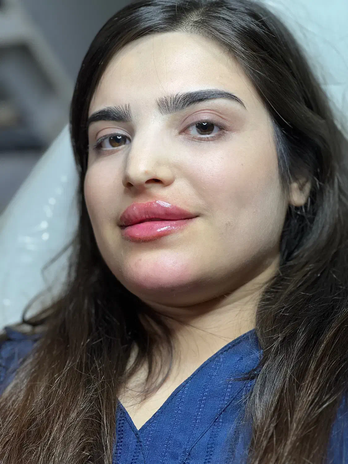 تزریق ژل وبوتاکس|خدمات آرایشگری و زیبایی|جوانرود, |دیوار