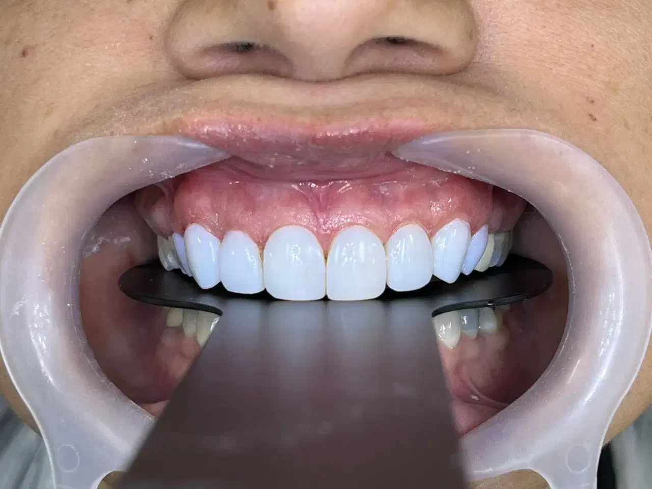 جشنواره روکش دندان فقط فقط 3/800|خدمات آرایشگری و زیبایی|شیراز, تندگویان|دیوار