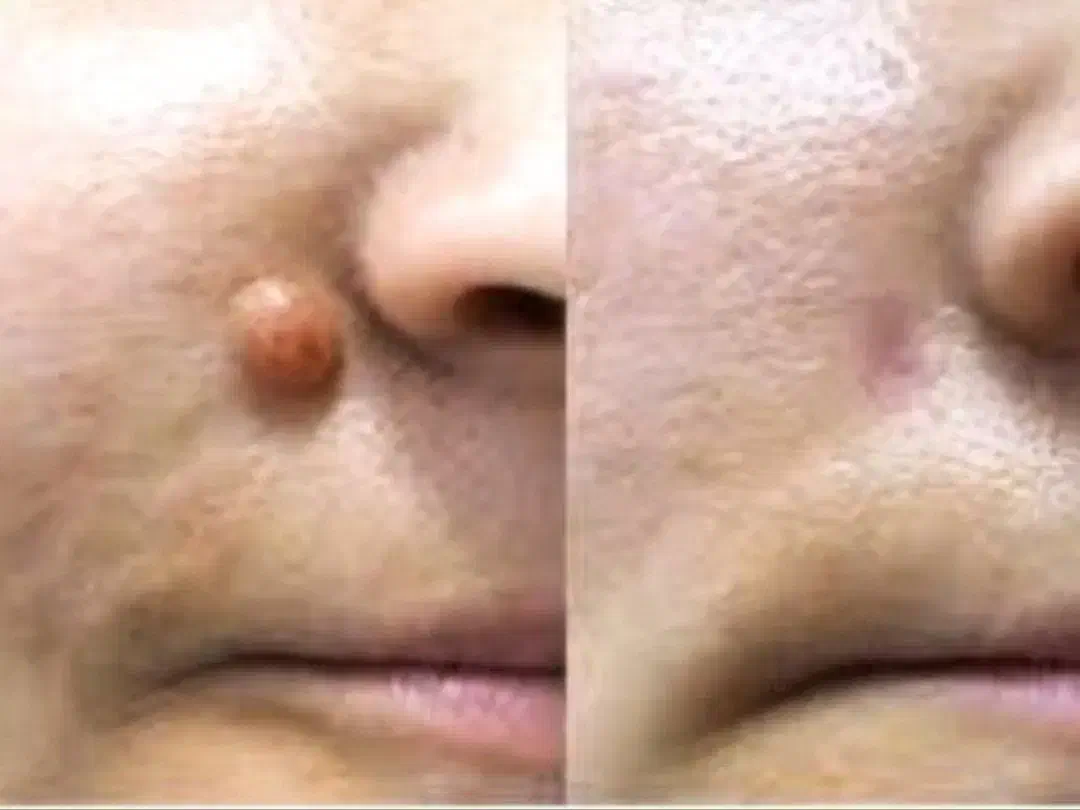 برداشتن خال ، خال گوشتی و میلیا فقط در یک جلسه|خدمات آرایشگری و زیبایی|کرج, اتحاد|دیوار