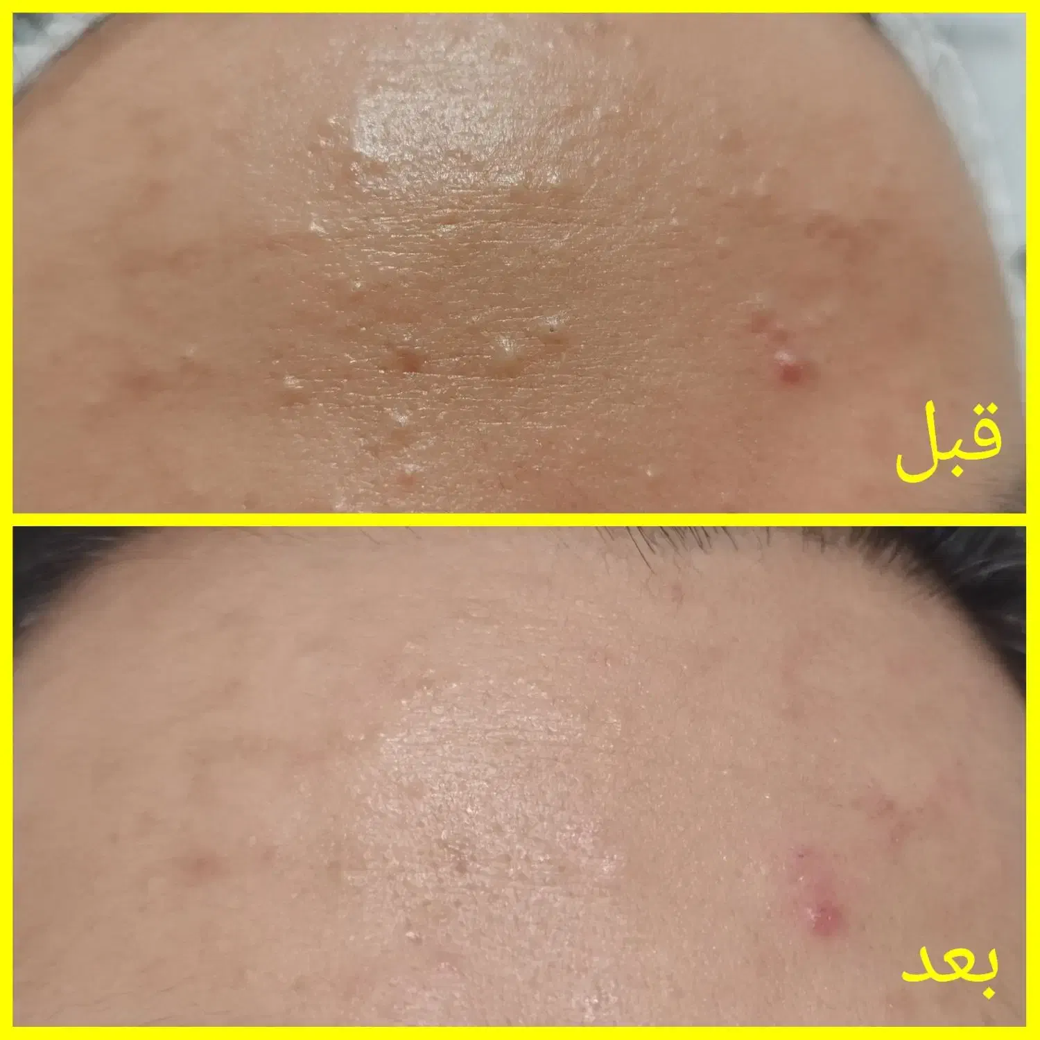 فیشیال و پاکسازی تخصصی پوست|خدمات آرایشگری و زیبایی|تهران, حکیمیه|دیوار
