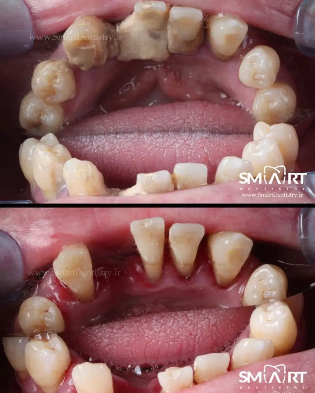 فقط امروز جرم گیری فک بالا و پایین|خدمات آرایشگری و زیبایی|تهران, اقدسیه|دیوار