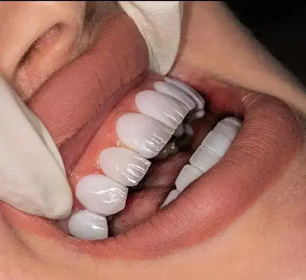 زیبایی لبخند با خدمات حرفه‌ای دندانپزشکی در پردیس|خدمات آرایشگری و زیبایی|بومهن, |دیوار