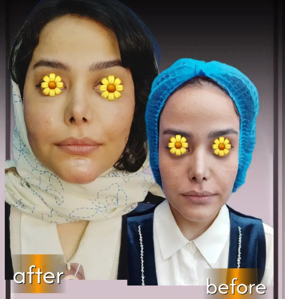 مرکز تخصصی تزریق فول فیس چربی و فیلر/لیفت با نخ|خدمات آرایشگری و زیبایی|مشهد, هنرستان|دیوار