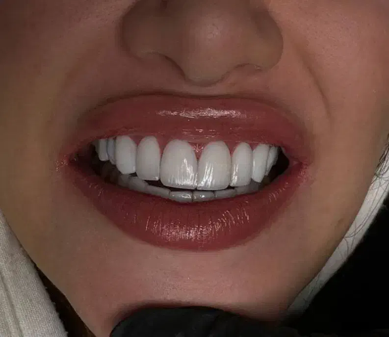 کامپوزیت ۴۰درصد تخفیف|خدمات آرایشگری و زیبایی|خرم‌آباد, |دیوار