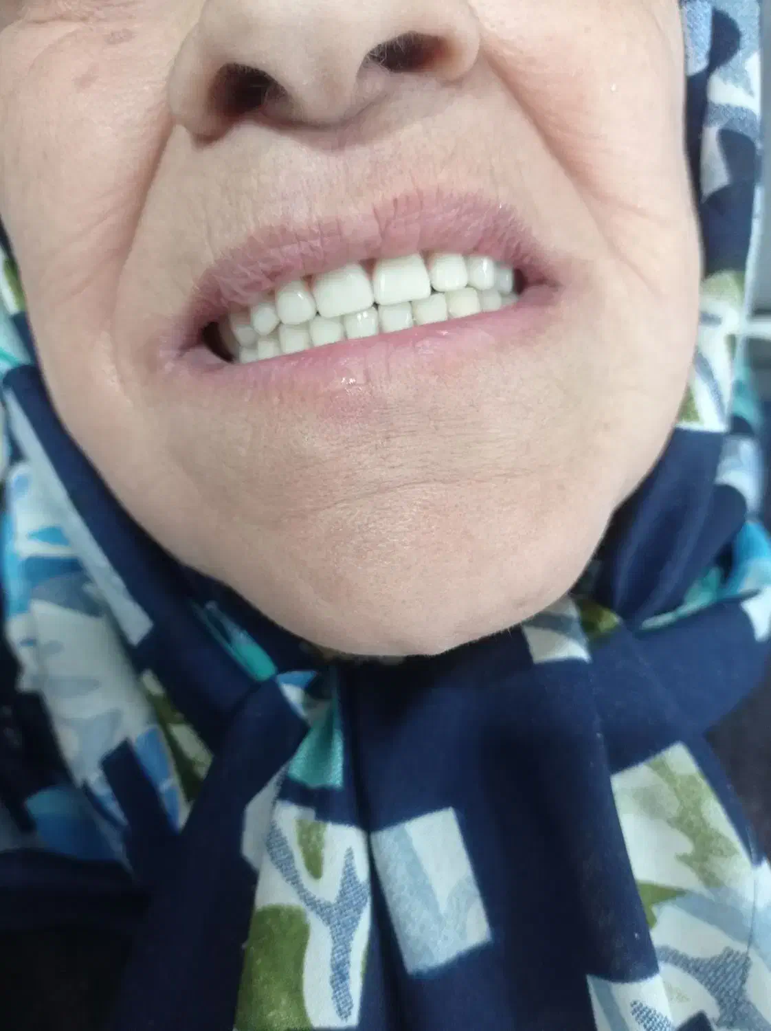 دندان مصنوعی لمینتی طرح لبخند|خدمات آرایشگری و زیبایی|محمدیه-قزوین, |دیوار