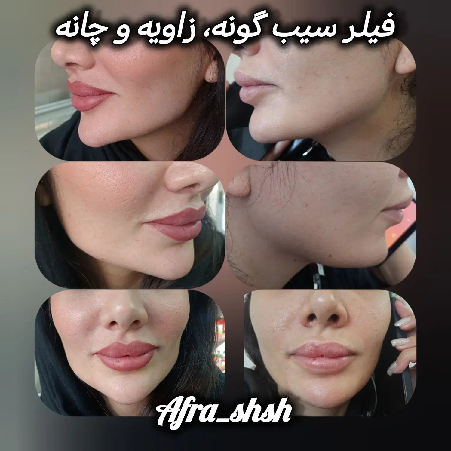 ژل و بوتاکس با ماندگاری بالا و قیمت ویژه|خدمات آرایشگری و زیبایی|شاهین‌شهر, شهرک گلدیس|دیوار