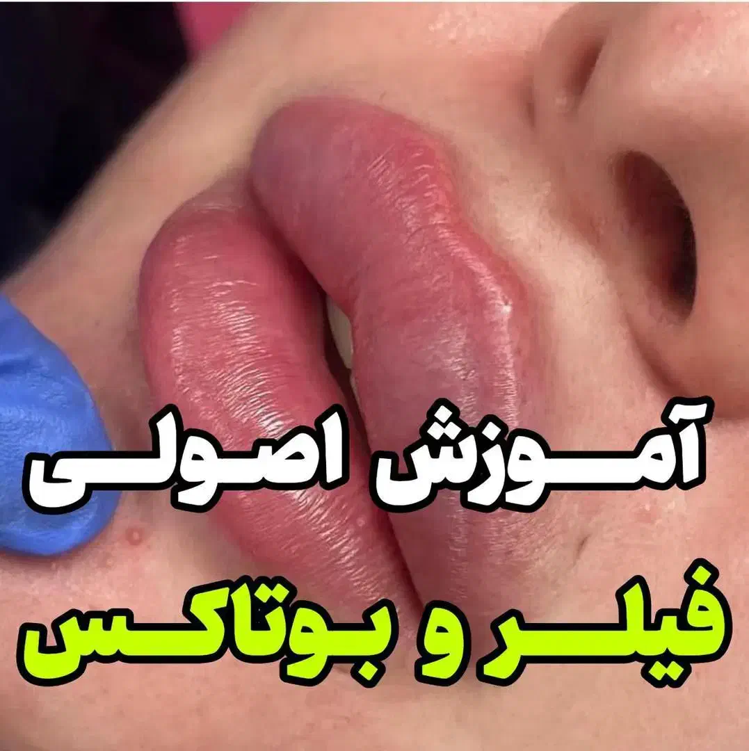 آموزش صفرتا۱۰۰ همه مباحث تزریق فیلر ژل بادی بوتاکس|خدمات آموزشی|شیراز, شریف‌آباد|دیوار