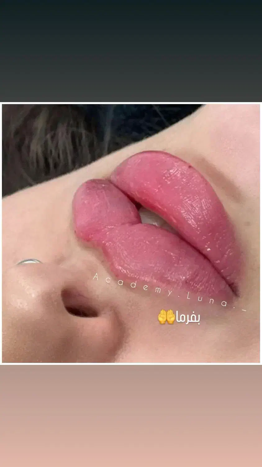 ژل بوتاکس|خدمات آرایشگری و زیبایی|قم, بکایی|دیوار