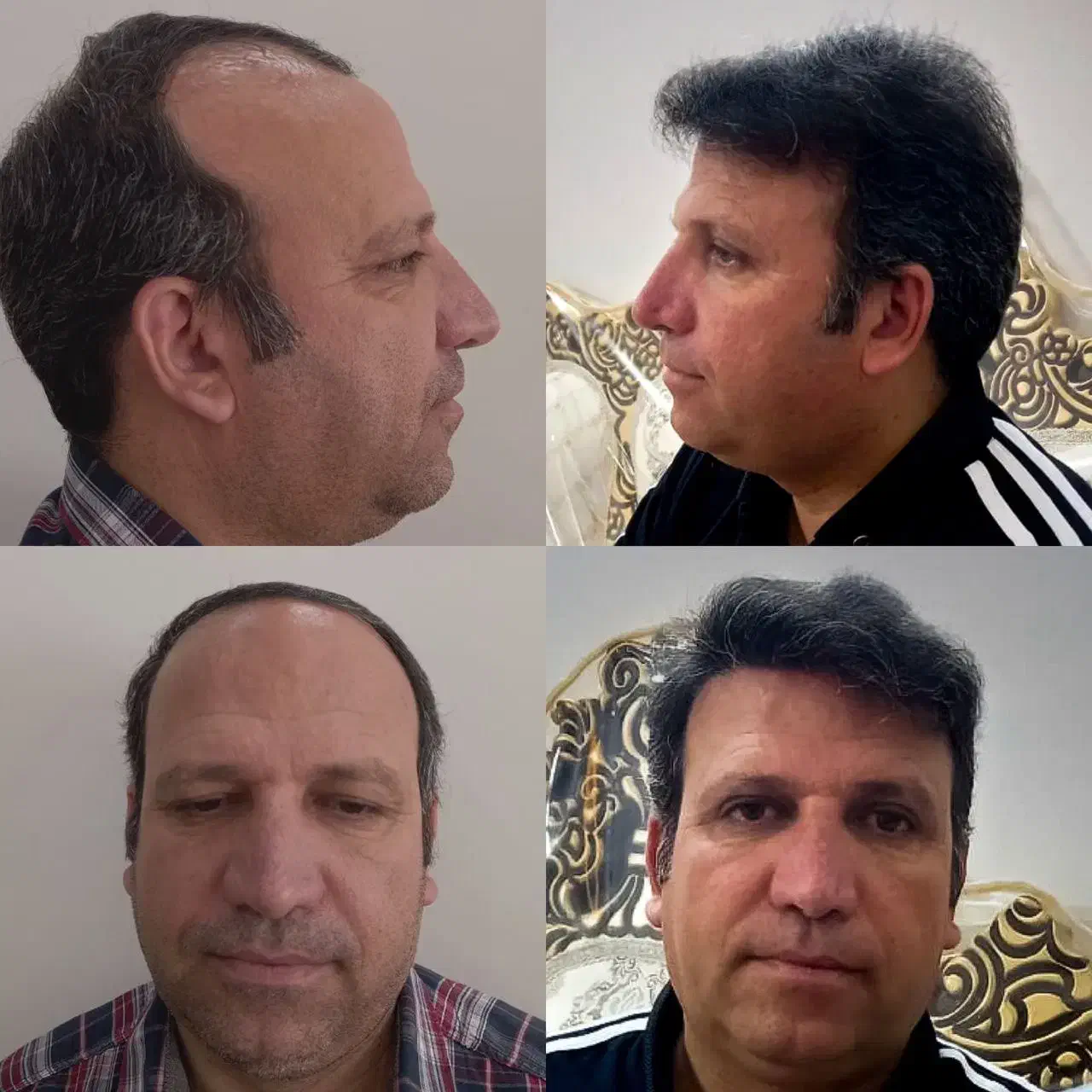کاشت مو/کاشتمو/کاشت ابرو/کاشت ریش یک مرحله|خدمات آرایشگری و زیبایی|نجف‌آباد, باغ ملی|دیوار