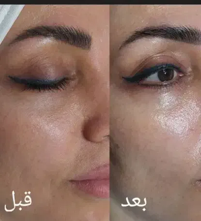 پاکسازی پوست|خدمات آرایشگری و زیبایی|اسلامآباد غرب, |دیوار