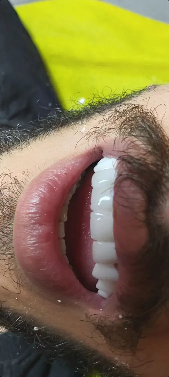 عصبکشی پر کردن ۱۳۰۰ روکش فروش رادیوگرافی|خدمات آرایشگری و زیبایی|مرند, |دیوار