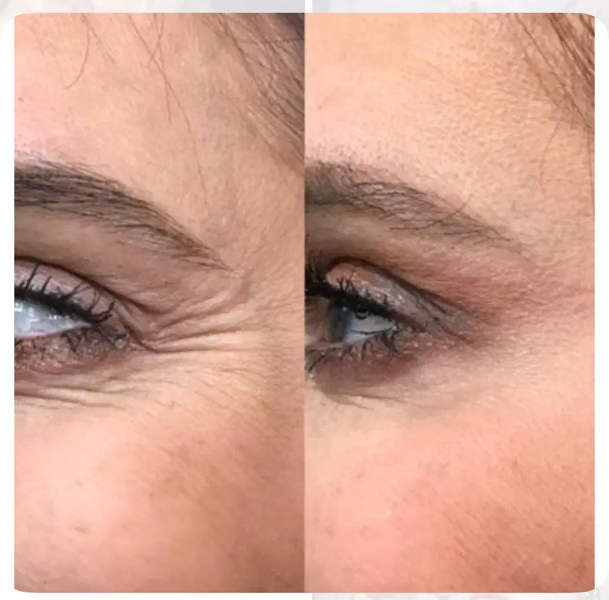 ژل بوتاکس مزوتراپی جوانساز فشیال پاکسازی|خدمات آرایشگری و زیبایی|اندیشه, اندیشه فاز ۱|دیوار