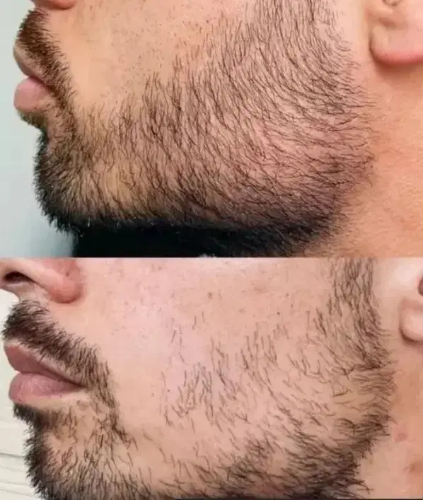 پی آرپی prp مزوتراپی مزونیدلینگ بوتاکس فشیال آنزیم|خدمات زیبایی و سلامت|تهران, دردشت|دیوار