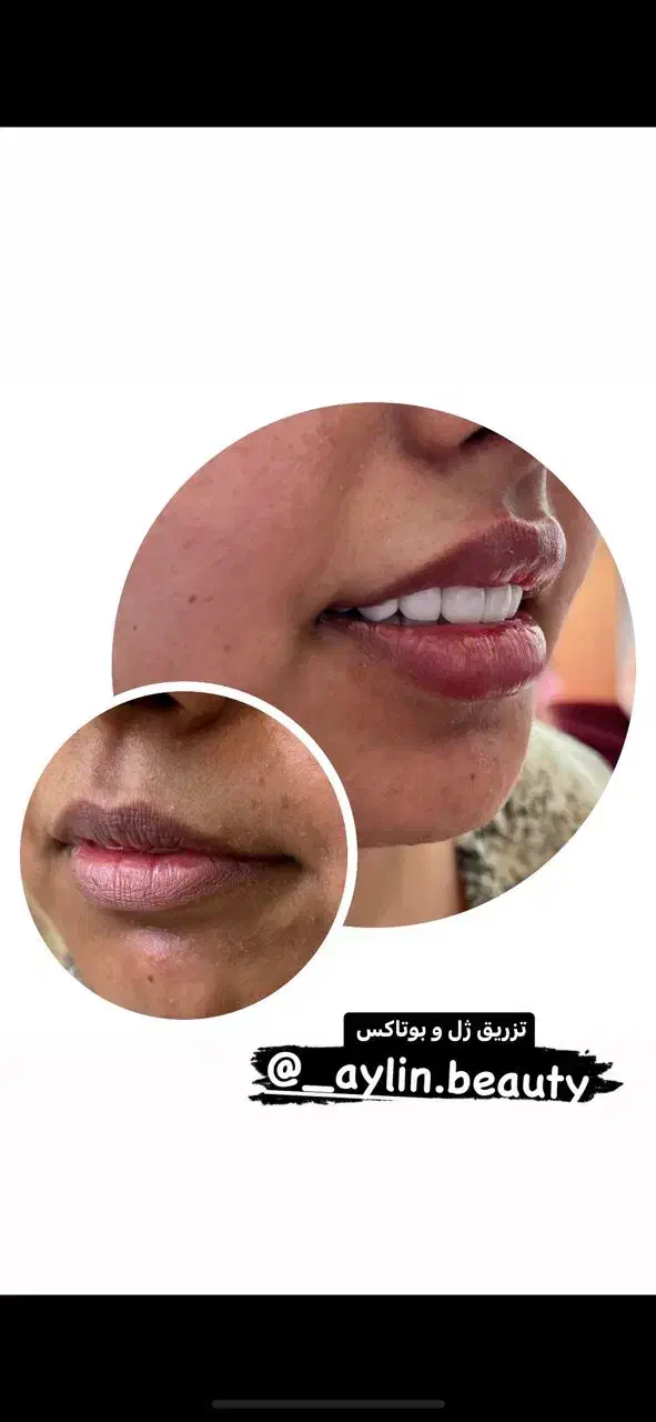 تزریقات ژل شروع قیمت از 750|خدمات آرایشگری و زیبایی|شیراز, شهرک مفتح|دیوار