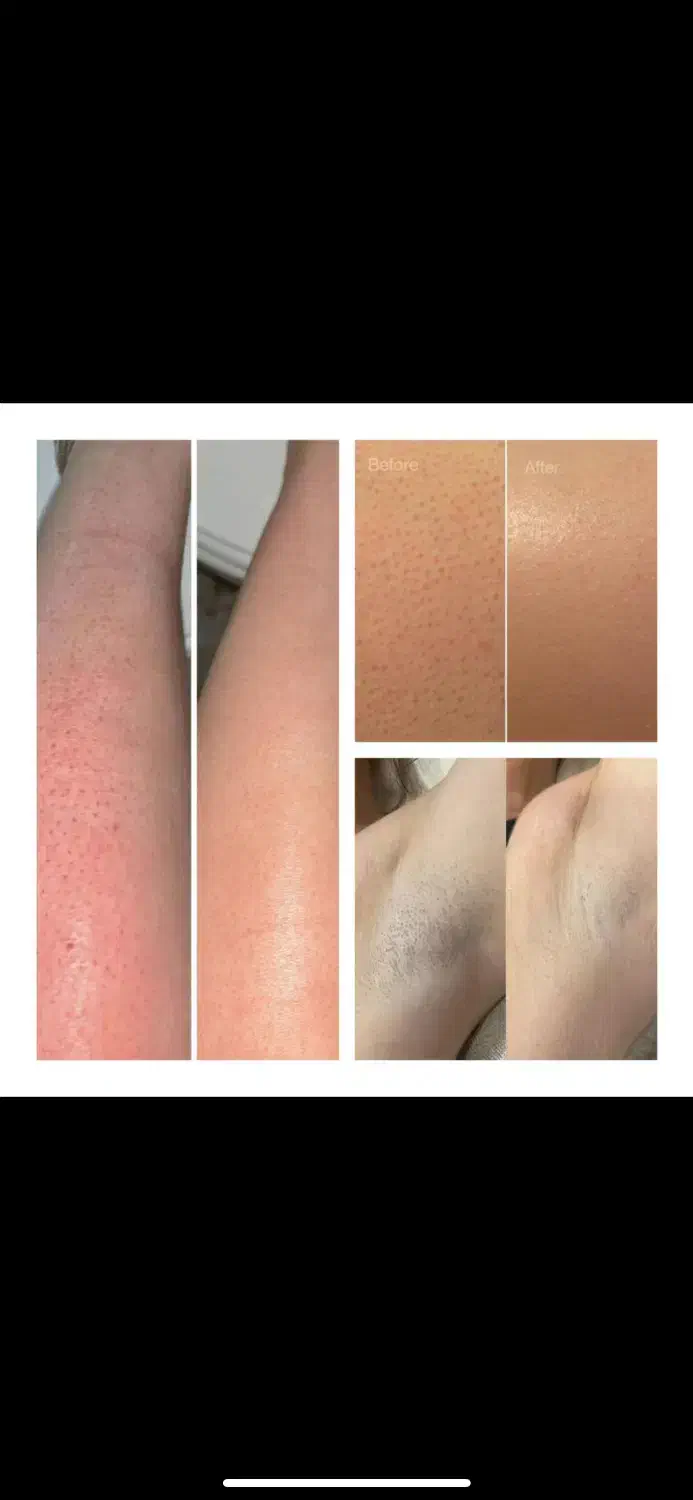 لیزر موهای زائد بدون درد -قیمت استثنایی 260ت|خدمات آرایشگری و زیبایی|ری, دولت‌آباد|دیوار