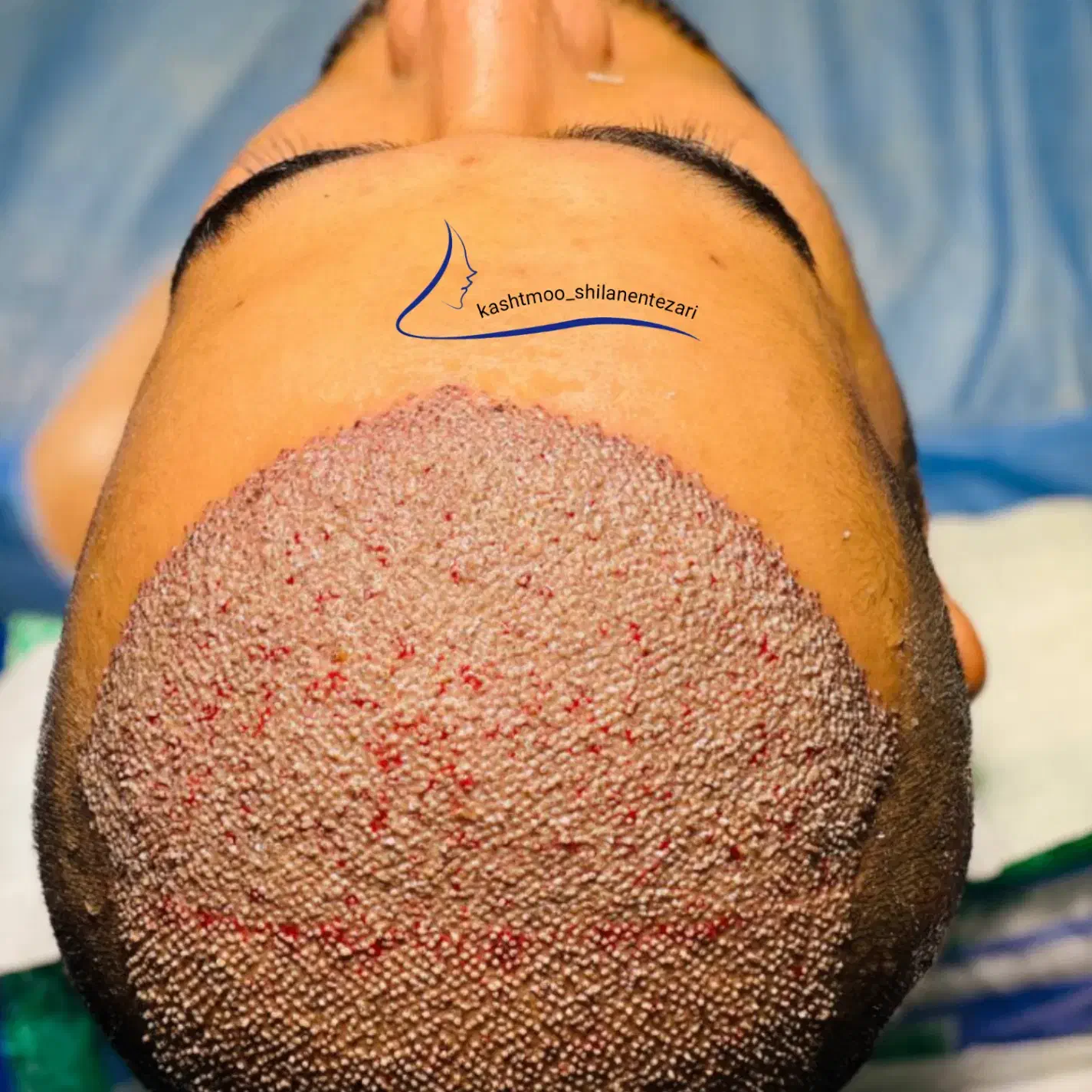 کاشت مو شیراز ارومیه|خدمات آرایشگری و زیبایی|پیرانشهر, |دیوار