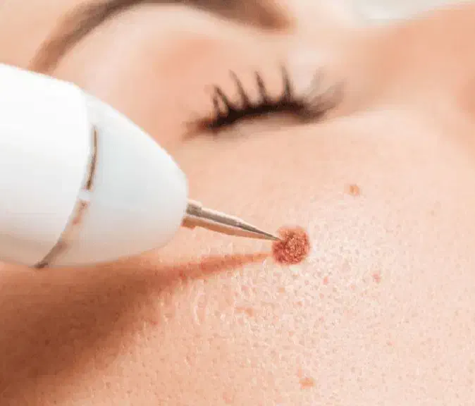 خال برداری|خدمات آرایشگری و زیبایی|دورود, |دیوار