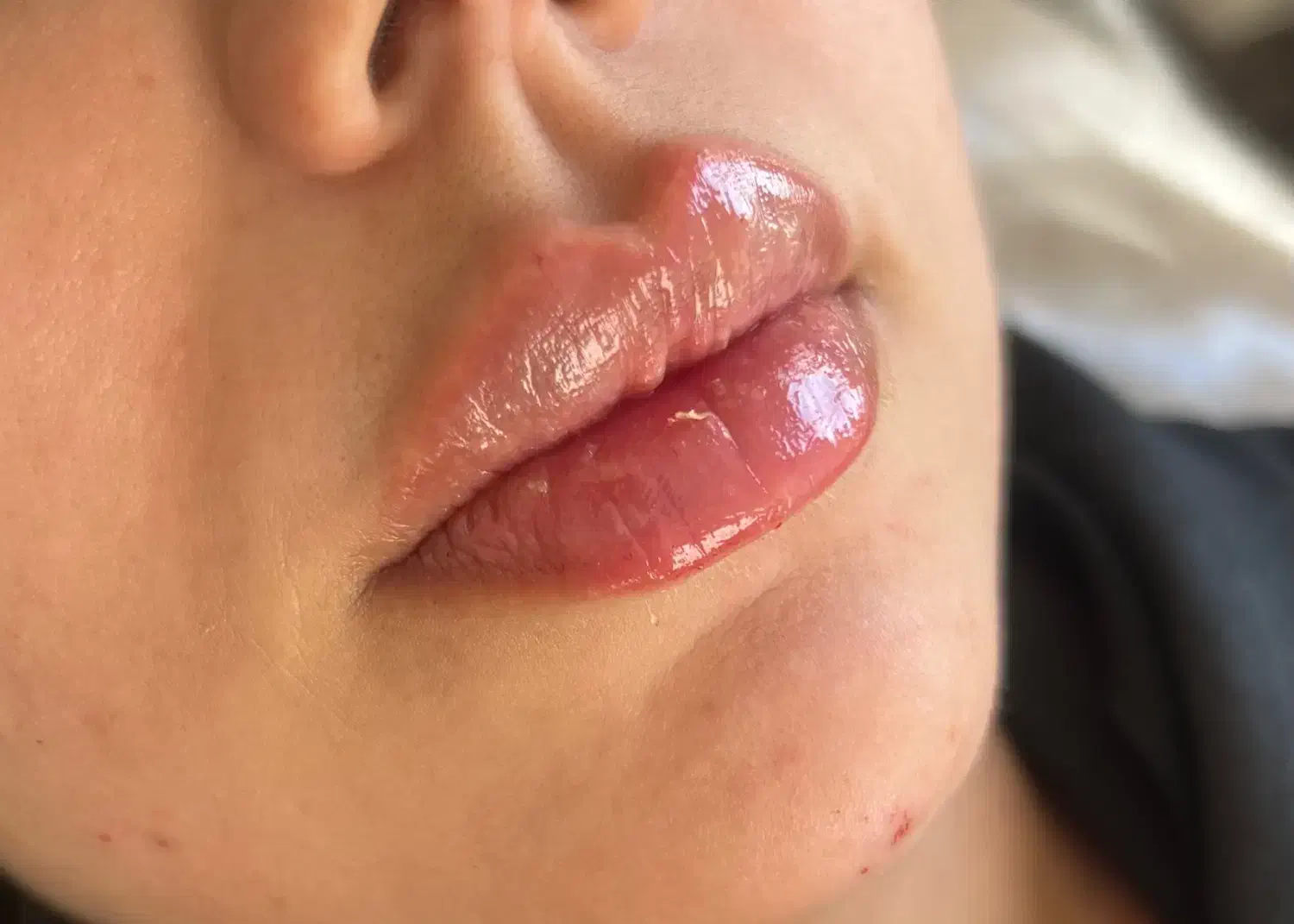 تزریقات فیلر و بوتاکس توسط پزشک|خدمات آرایشگری و زیبایی|تهران, جوادیه|دیوار