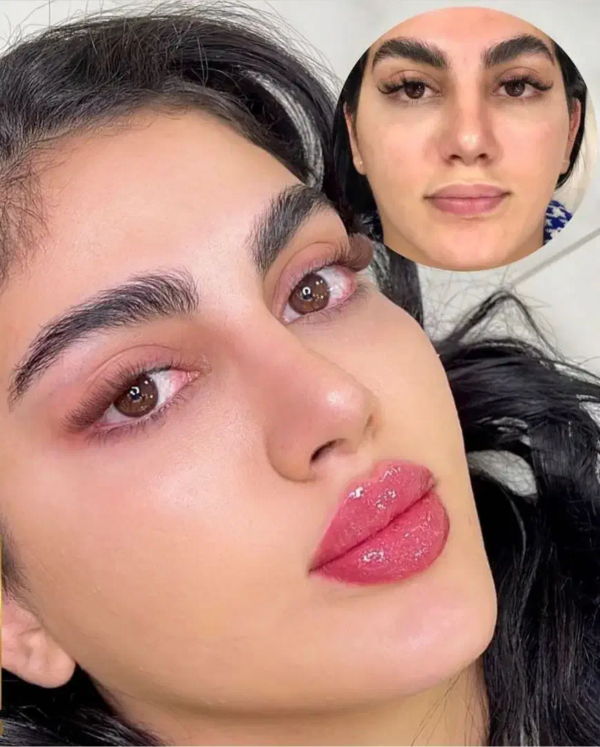 لیزرموهای زائد،ژل لب فول فیس زاویه مزوبوتاکس هایفو|خدمات آرایشگری و زیبایی|مشهد, آزادشهر|دیوار