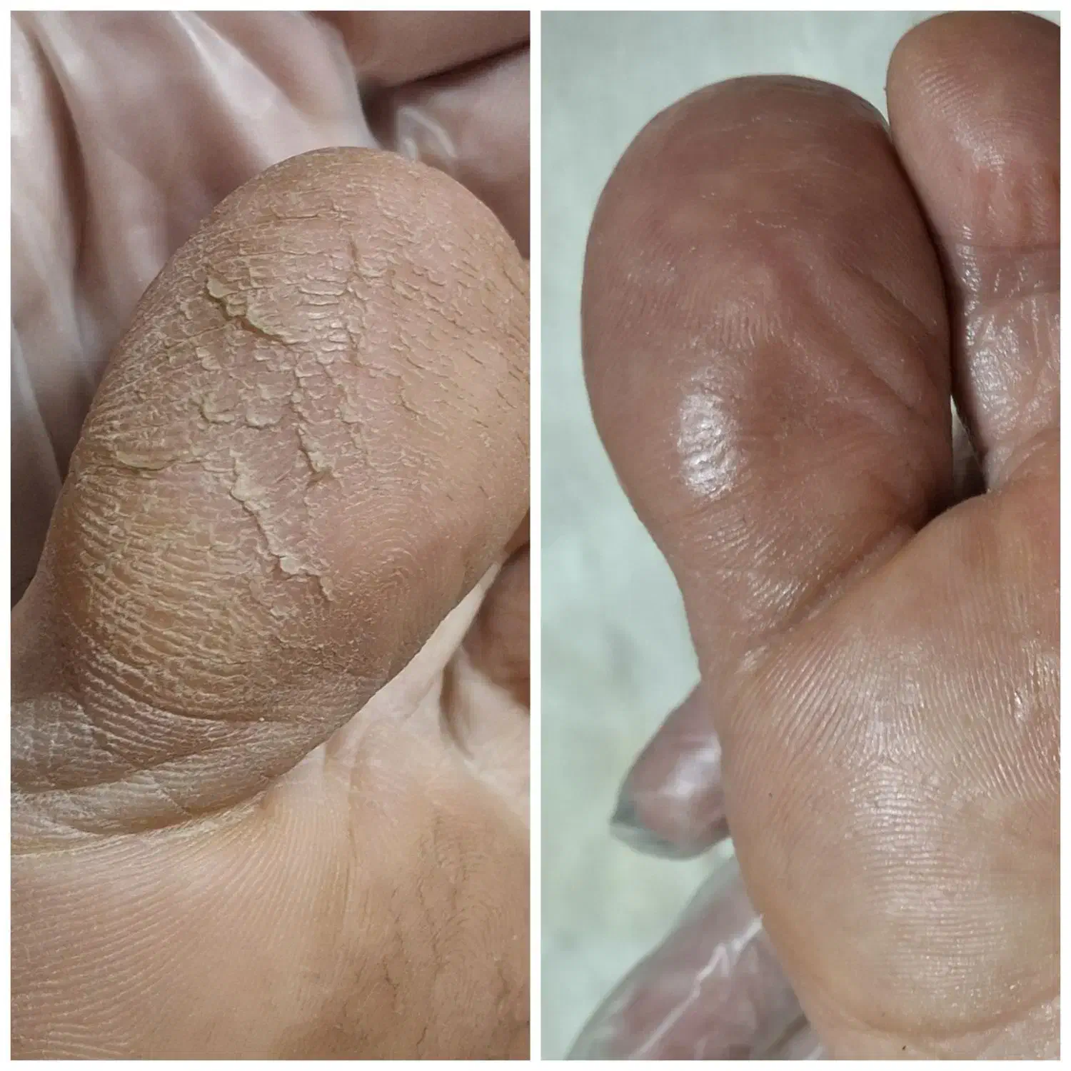 پدیکور درمانی آقایان در کلینیک پوست دریک‌جلسه|خدمات آرایشگری و زیبایی|پردیس, فاز ۲|دیوار