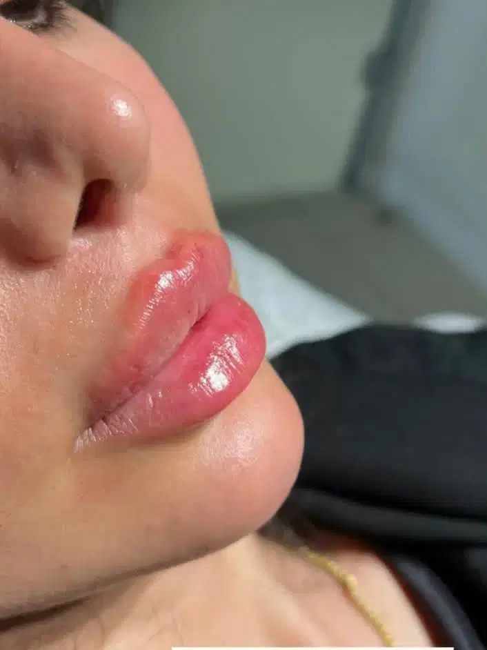 تزریق ژل و بوتاکس ویژه مرداد|خدمات زیبایی و سلامت|تهران, عبدل‌آباد|دیوار