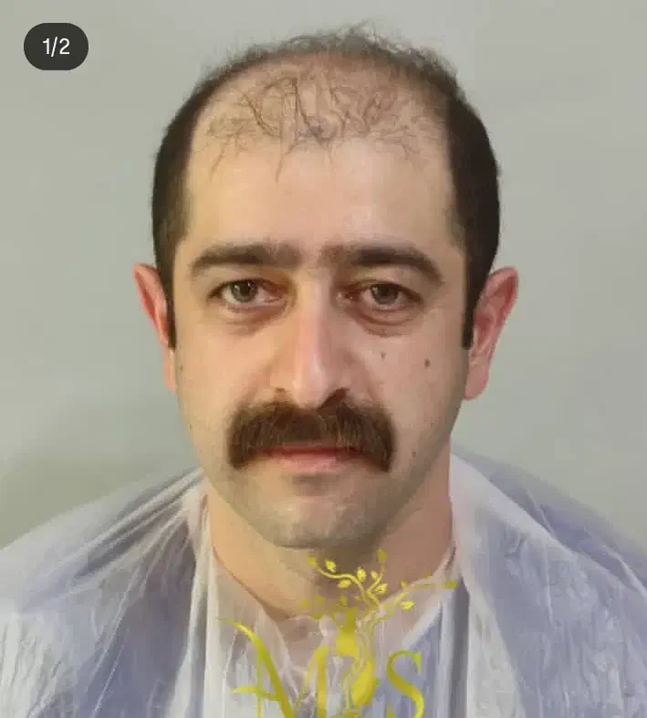 کاشت مو فقط 21میلیون تخفیف ویژه شب یلدا|خدمات آرایشگری و زیبایی|اردبیل, |دیوار