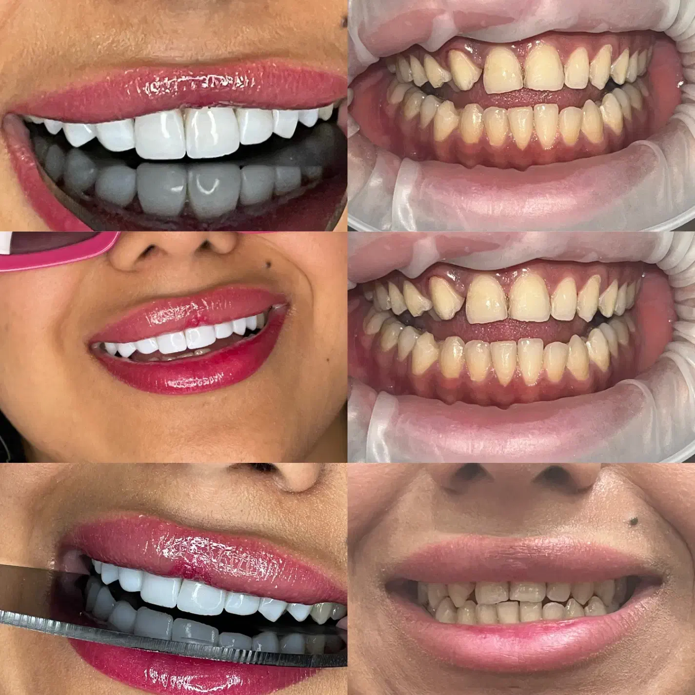 کامپوزیت و لمینت دندان|خدمات آرایشگری و زیبایی|ساری, |دیوار