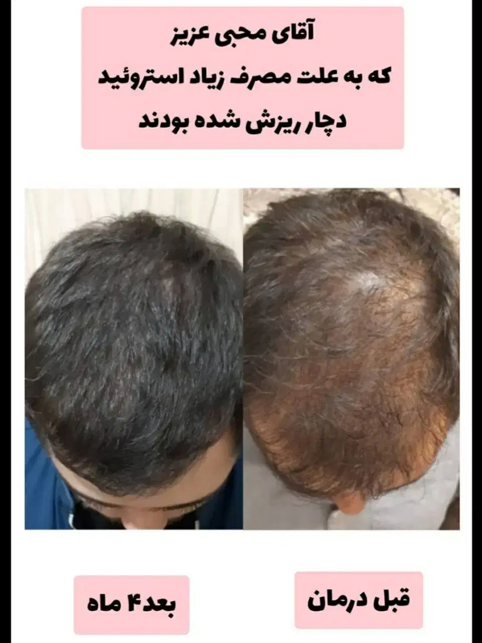 درمان ریزش و رویش مجدد مو|آرایشی، بهداشتی، درمانی|لاهیجان, بازکیاگوراب|دیوار
