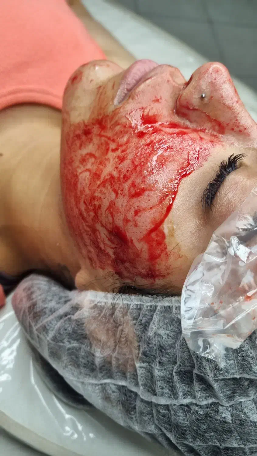 تخفیف مزوتراپی صورت|خدمات آرایشگری و زیبایی|قائم‌شهر, |دیوار