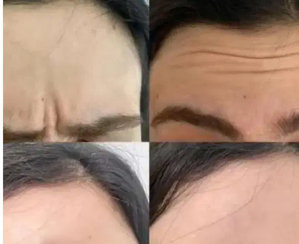 تزریقات زیبایی|خدمات آرایشگری و زیبایی|قرچک, مهدیه|دیوار