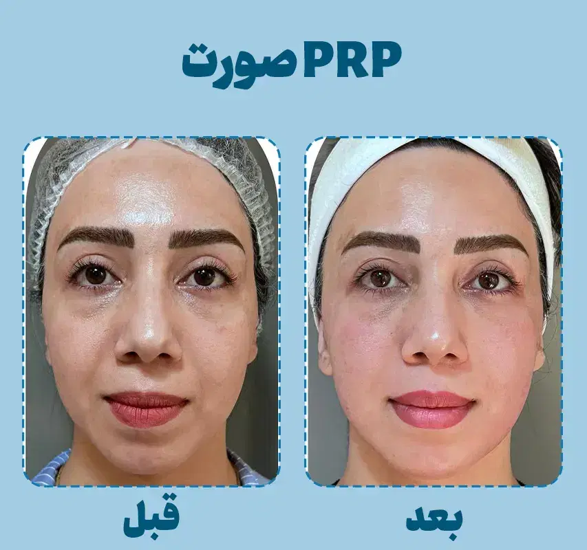 پی آر پی(جوانسازدرمان لک جوش قطع ریزش)مطب پزشک499|خدمات زیبایی و سلامت|اصفهان, ملکشهر|دیوار