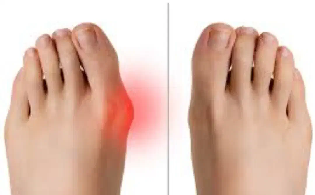 کلینبک درمان هالوکس والگوس (شصت پای کج)|خدمات آرایشگری و زیبایی|قروه, |دیوار