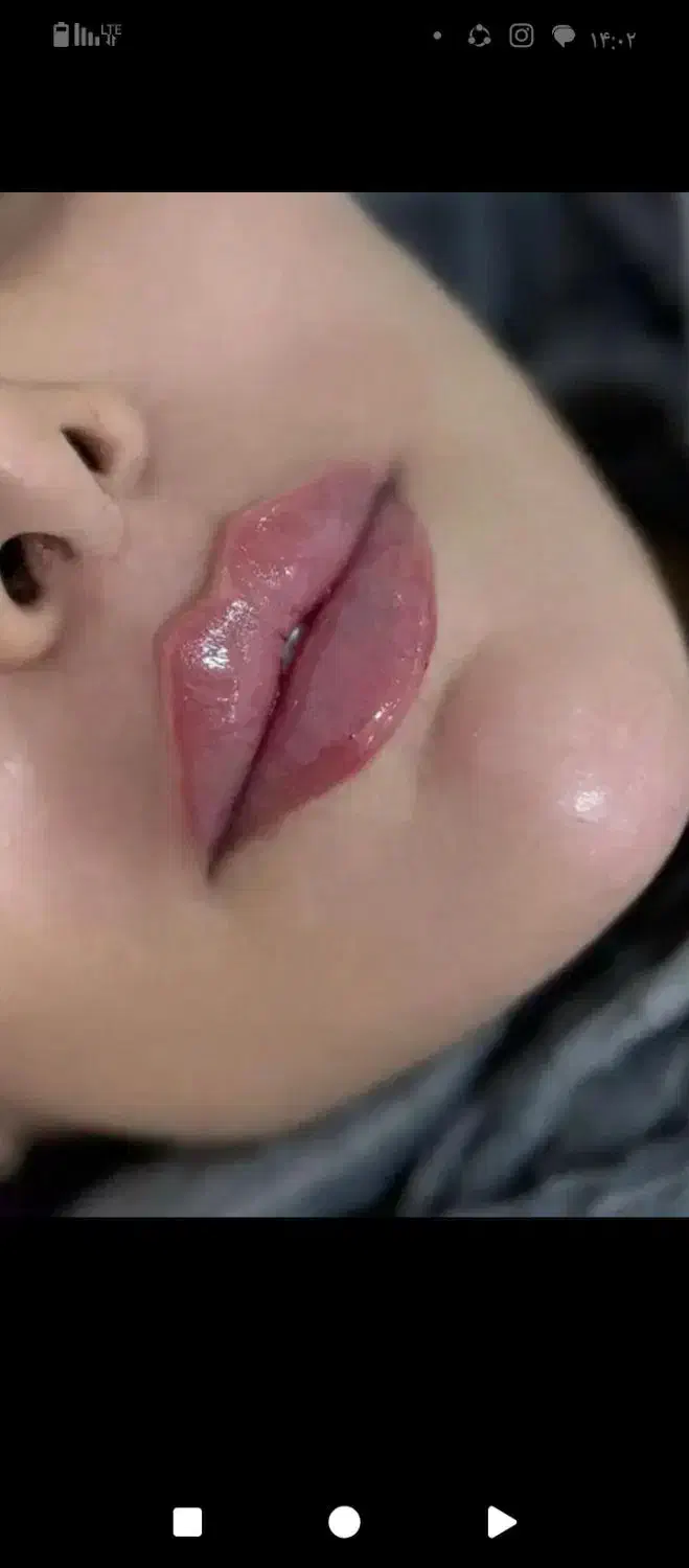 آموزش و تزریق ژل و بوتاکس|خدمات آرایشگری و زیبایی|اسلامشهر, شهرک سالور|دیوار