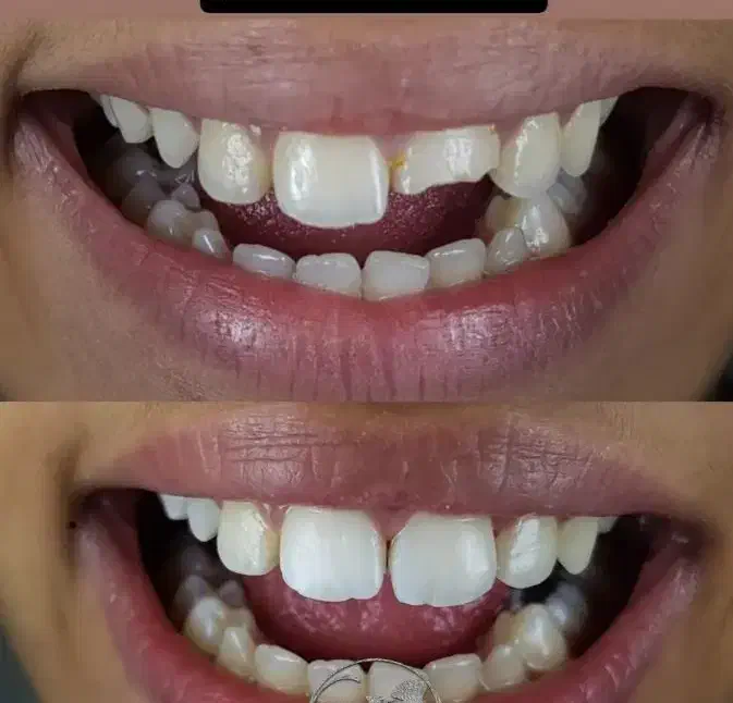 ترمیم و پر کردن دندان فقط ۱ میلیون و ۳۰۰|خدمات آرایشگری و زیبایی|ورامین, خیر آباد|دیوار