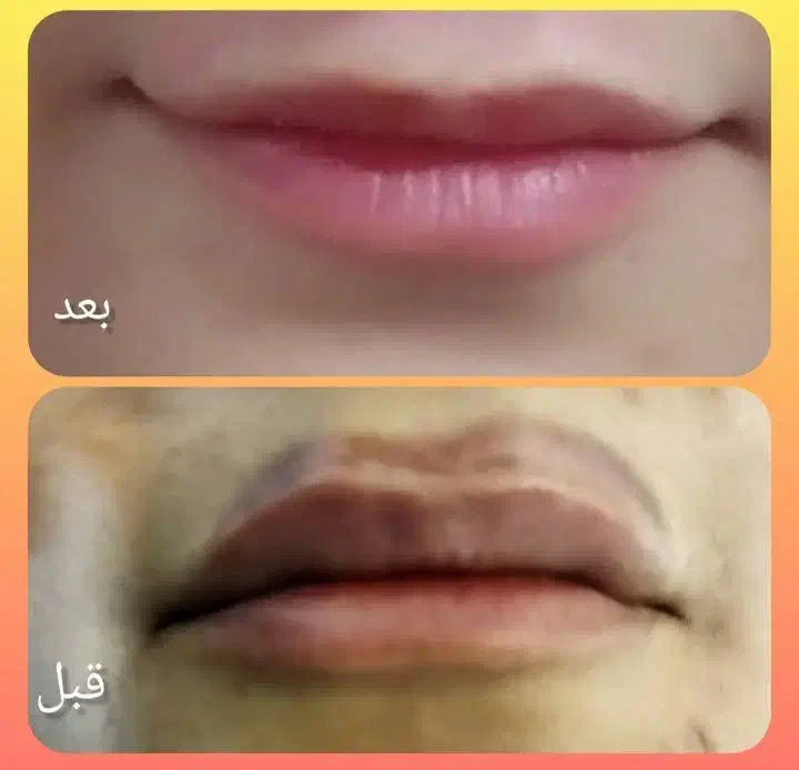 ریموو تتو با لیزر کیوسوییچ|خدمات آرایشگری و زیبایی|خرم‌آباد, |دیوار