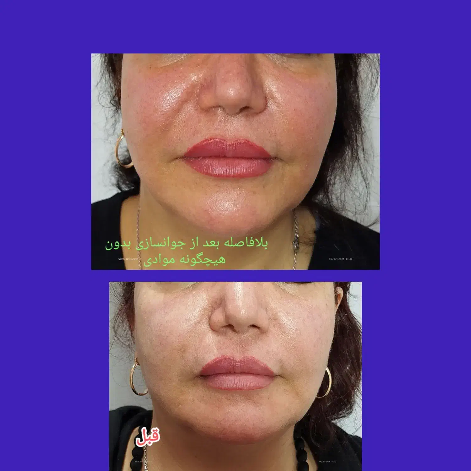 جوانسازی قوی بدون مواد|خدمات آرایشگری و زیبایی|رشت, کاکتوس|دیوار