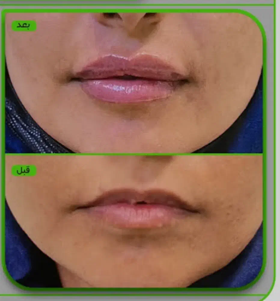 ژل لب،چونه ،آنزیم ،زاویه ،بوتاکس|خدمات آرایشگری و زیبایی|قم, تولید دارو و یخچال|دیوار