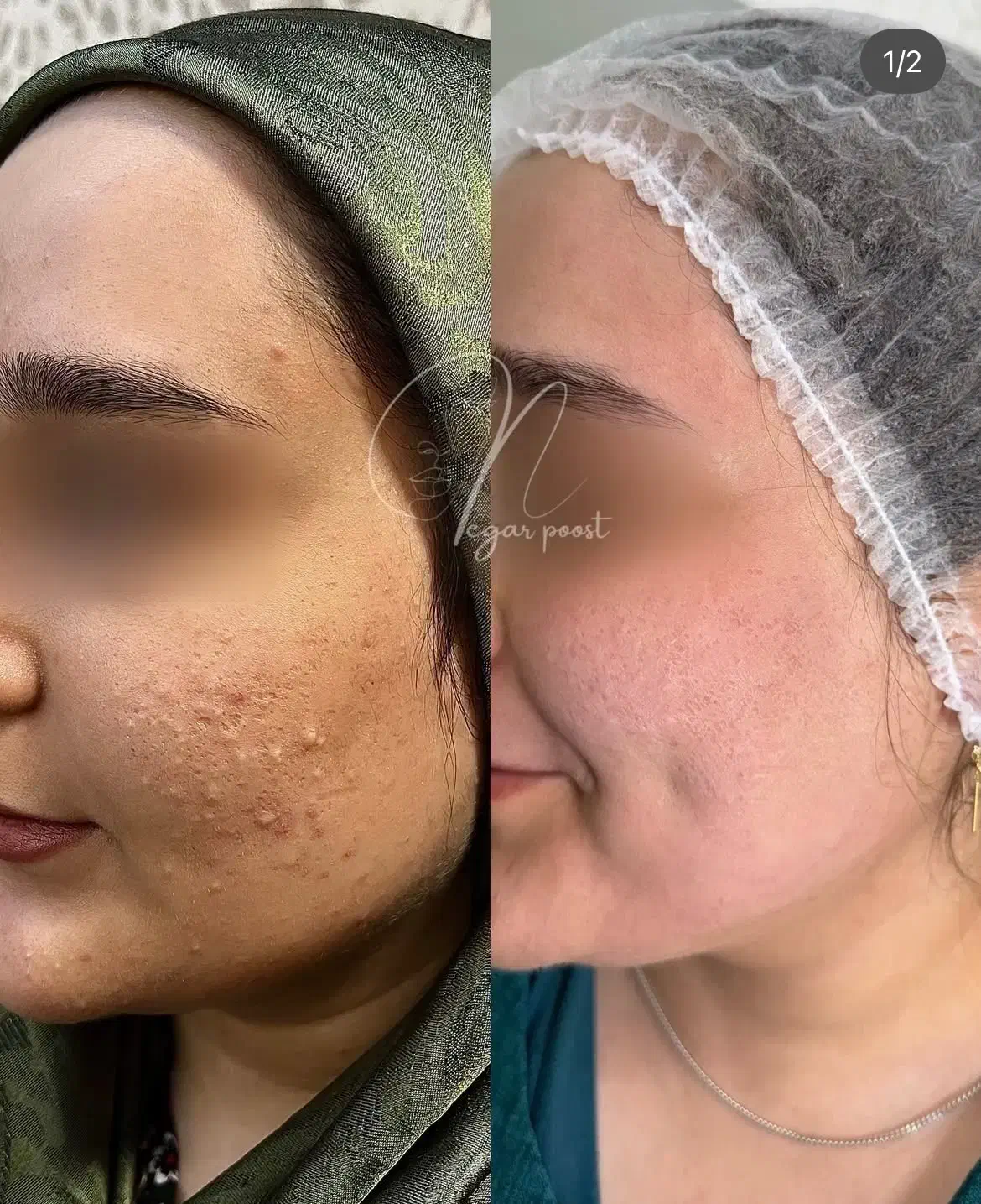 مدل جهت کار درمان تلفیقی پوست|خدمات آرایشگری و زیبایی|چالوس, |دیوار