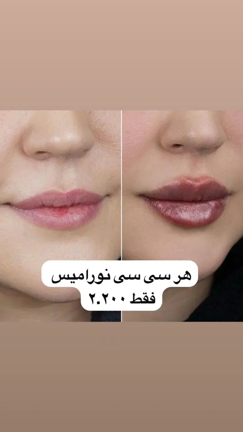 هایفو، فیلر، بوتاکس|خدمات آرایشگری و زیبایی|تهران, جیحون|دیوار